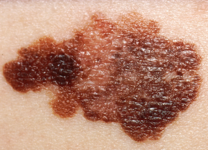 May is Melanoma month and Progressions salon spa