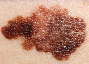 Close-up of an irregularly shaped and colored skin lesion on pale skin, displaying variegated shades of brown and an uneven, rough texture.